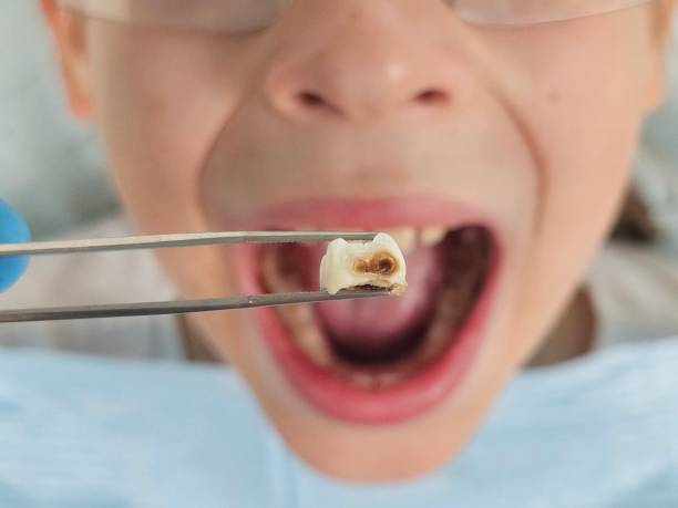 Best Emergency Wisdom Teeth Removal in Cheney, WA